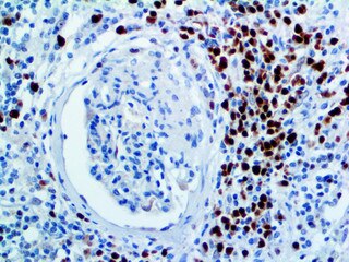 IHC of MUM1 on an FFPE Kidney Tissue